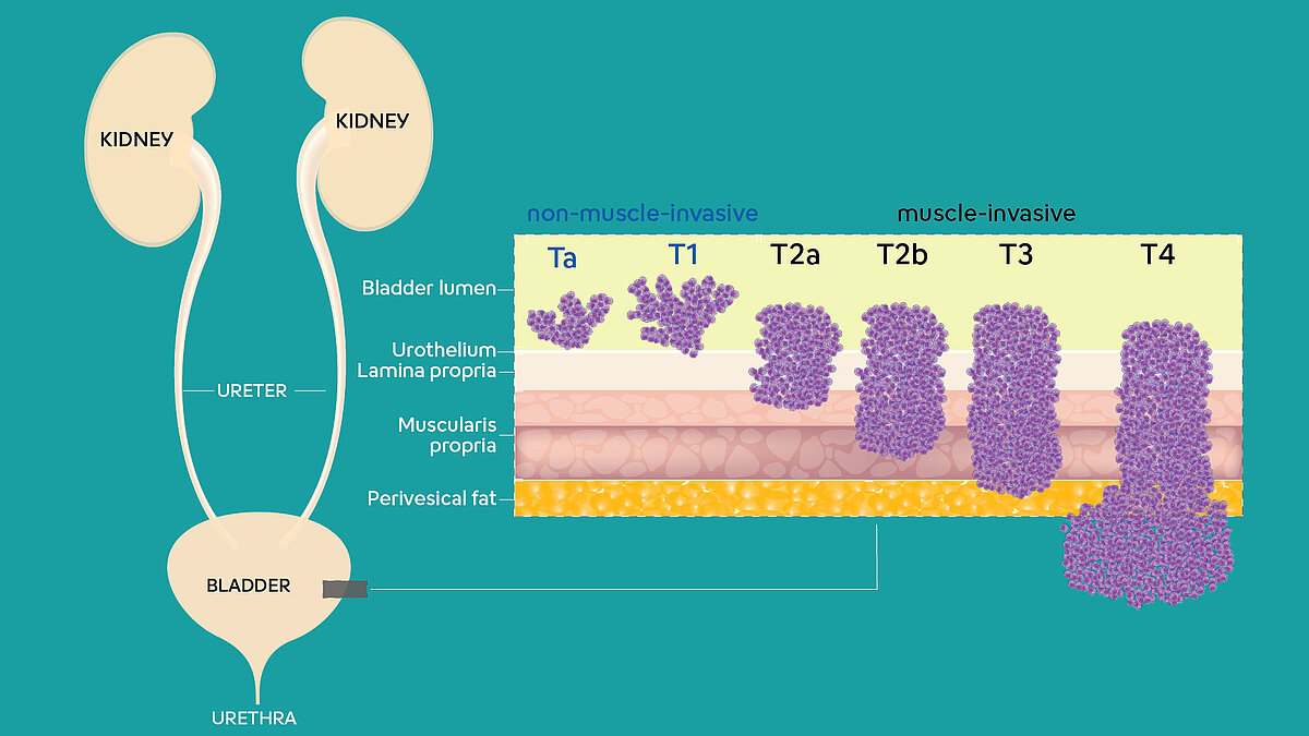 Illustration des voies urinaires comprenant les reins, les uretères, la vessie et l'urètre, ainsi qu'une illustration montrant les différents stades du cancer de la vessie.