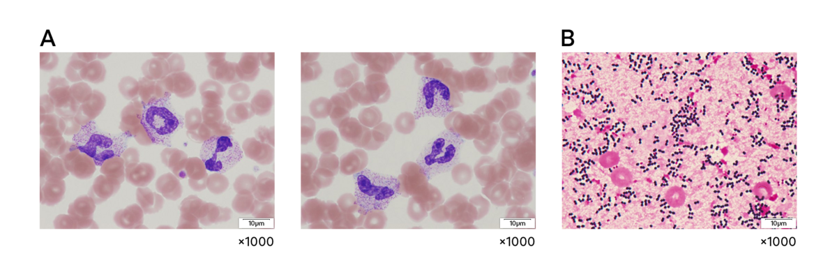 Fig. 3 (A) The patient’s peripheral blood smear showed toxic granulation of neutrophils. (B) The blood culture (gram staining) was tested positive for Staphylococcus aureus.